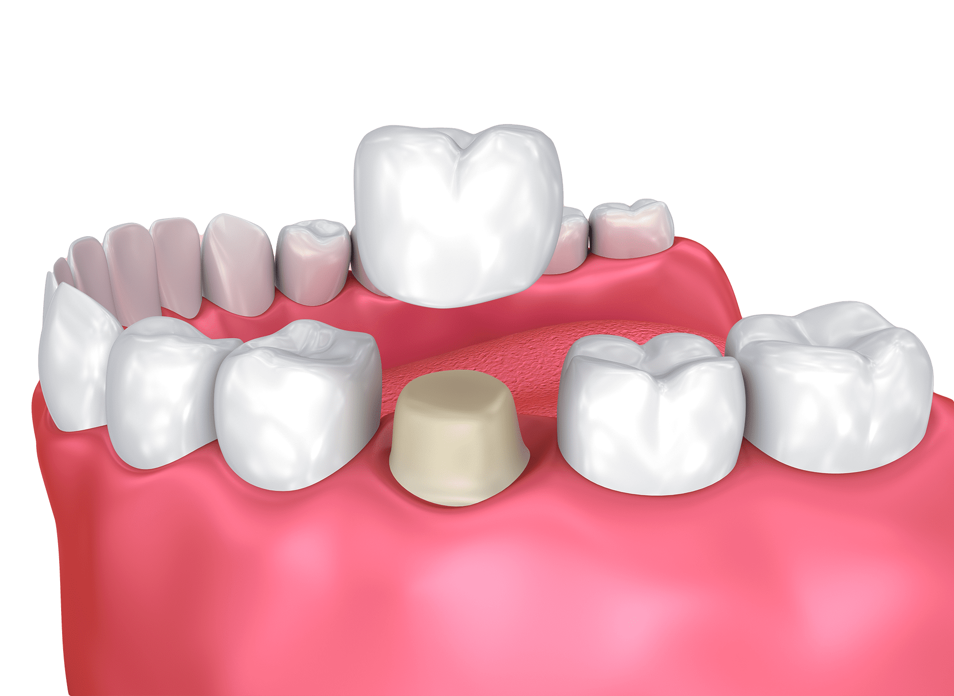 Tooth crown in Lakeland, FL