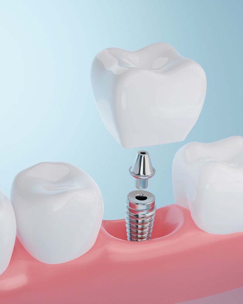 dental implants in lakeland